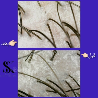 فیشال ضدجوش و آکنه